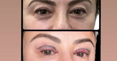 montagem com fotos de olhos antes e depois de cirurgia - metrópoles